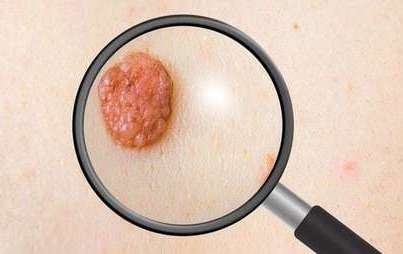 Zdjęcie do XI Tydzień Świadomości Czerniaka